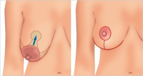 Push-Up Ped™-Sine dikleşdirici